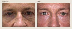 Fraxel eyelids resurfacing