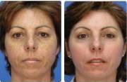 microlaser peel before and after
