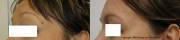 Mole removal before after