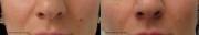Mole Removal Before After