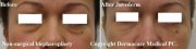 non-surgical-blepharoplasty-before-after