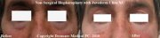non-surgical blepharoplasty male