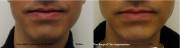 Non-surgical chin augmentation same patient front view