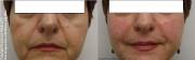 Cheek Augmentation with Radiesse