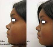 Non surgical nose job with Juvederm