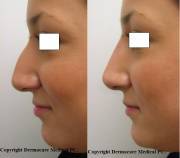 Non-surgical nose job before and after