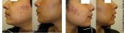 Before and After 2 PDT Sessions