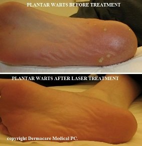 plantar warts