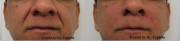 Before and Right After Radiesse Correction
