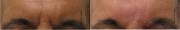 Before and Right After Radiesse Correction