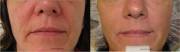 Before and After Radiesse Correction