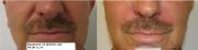 Before and Right After Radiesse Correction