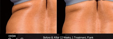 sculpsure 