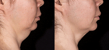 sculpsure submental fat reduction