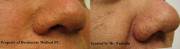 Before and After Radiosurgery for Sebaceous Hyperlasia