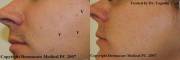 Before and After Radiosurgery removal of sebaceous hyperplasia
