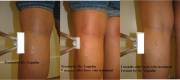 Veins Before and After one Session