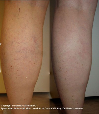spider veins laser removal
