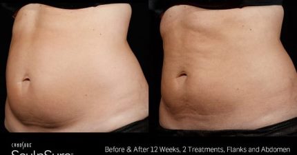 Sculpsure before and after