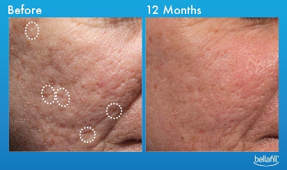 bellafill filler